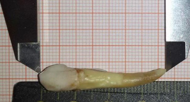 Guinessov rekord: Njemački zubar izvadio Hrvatu zub veličine 37,2 milimetra